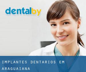 Implantes dentários em Araguaiana