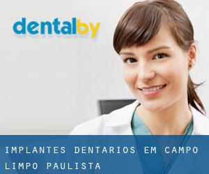 Implantes dentários em Campo Limpo Paulista