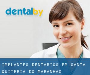 Implantes dentários em Santa Quitéria do Maranhão